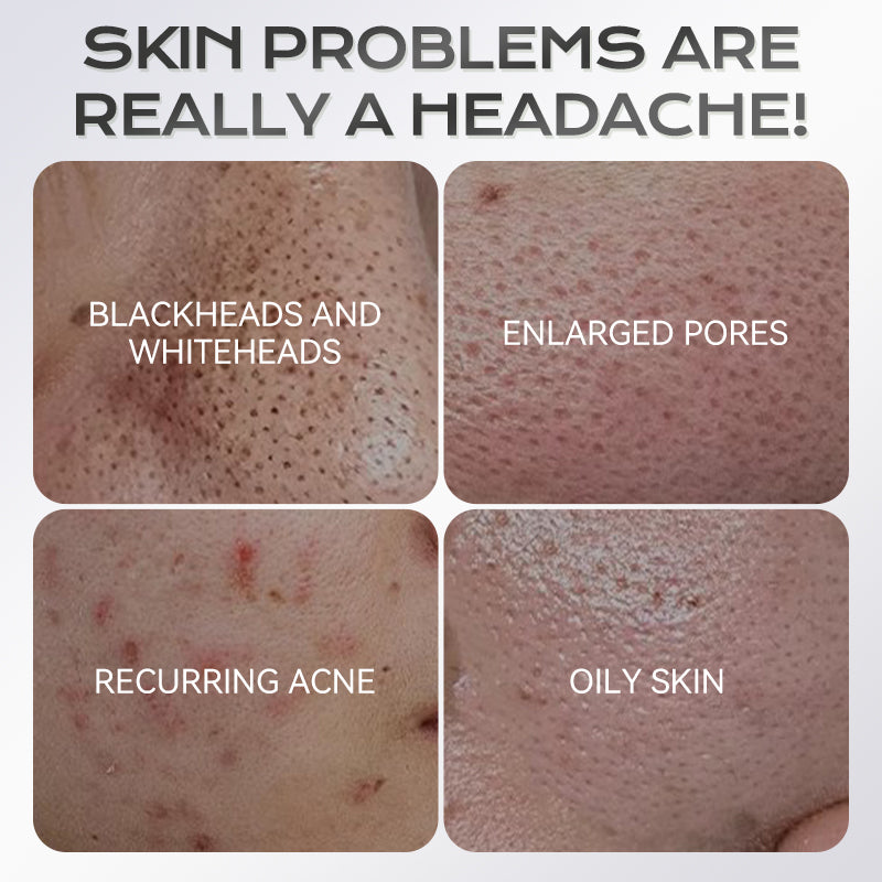 ✨ Pożegnaj się z chaosem związanym z maseczkami — paleta maseczek glinkowych z kwasem azelainowym! ✨