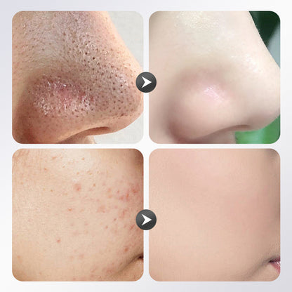 ✨ Pożegnaj się z chaosem związanym z maseczkami — paleta maseczek glinkowych z kwasem azelainowym! ✨